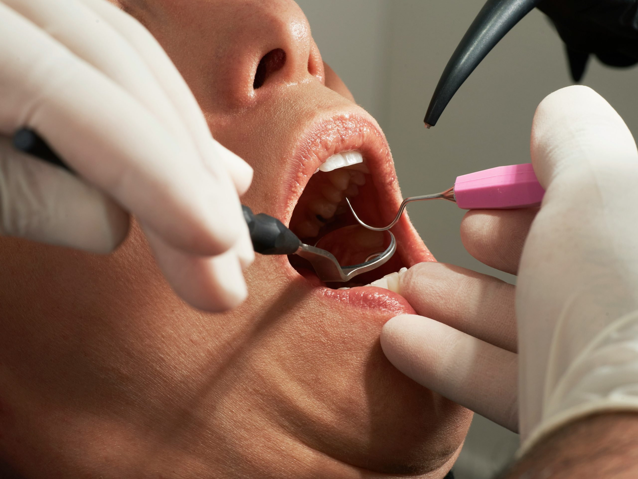 Understanding Gum Disease: Signs, Causes, and Treatments in White Rock