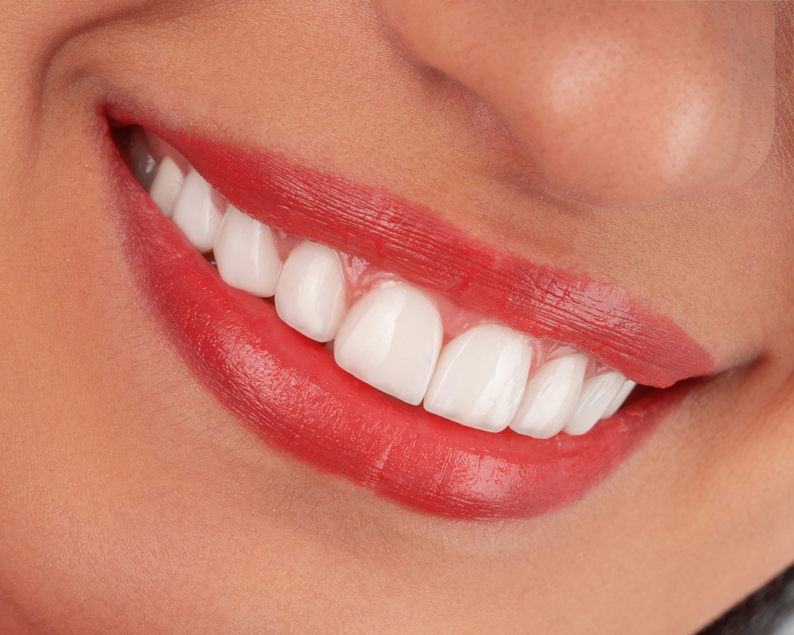 Professional Teeth Whitening vs. Store-Bought Kits